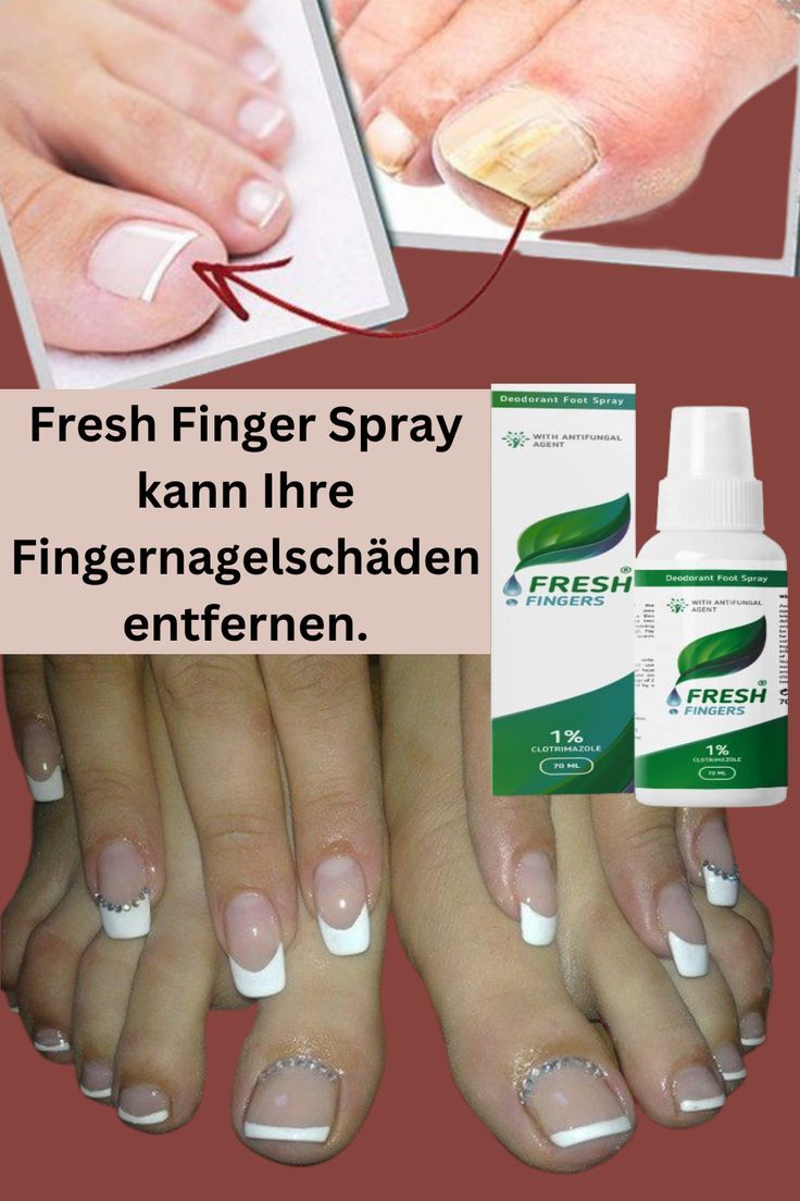 Fresh Finger Spray kann Ihre Fingernagelschäden entfernen.